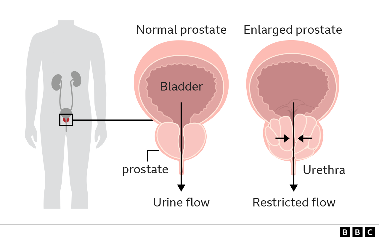 graphic of prostate