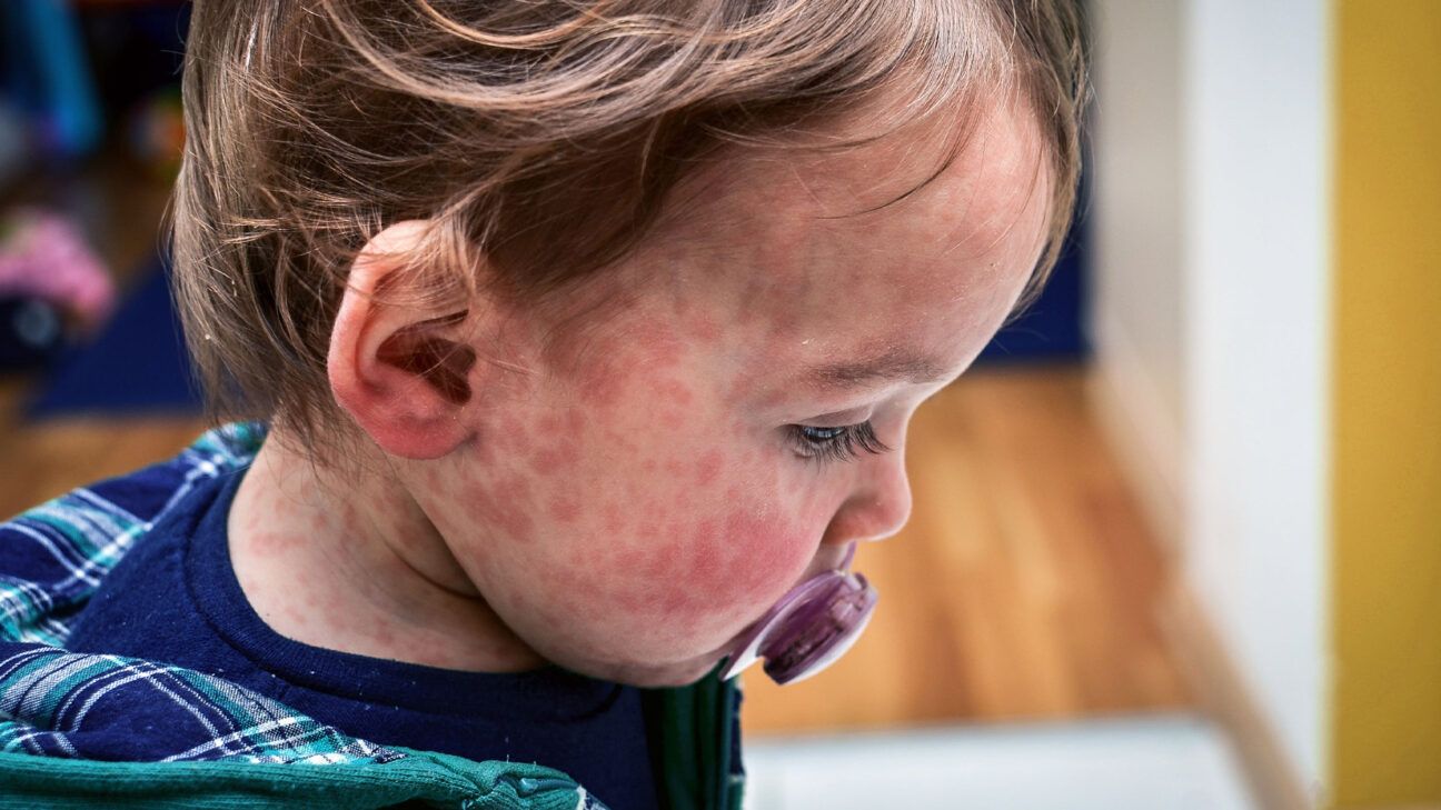 A toddler with measles is seen in close up.